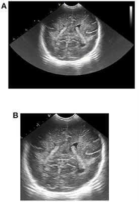 Analysis of cranial ultrasound images for newborn